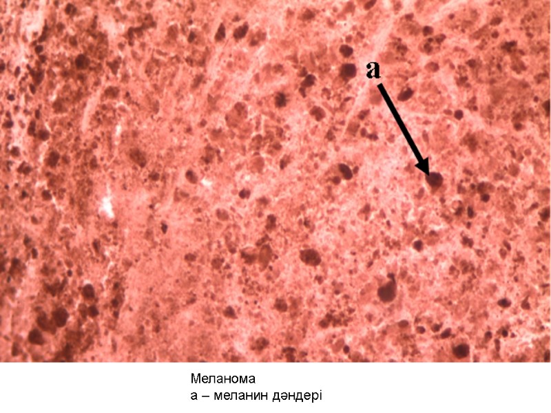 Меланома а – меланин дәндері